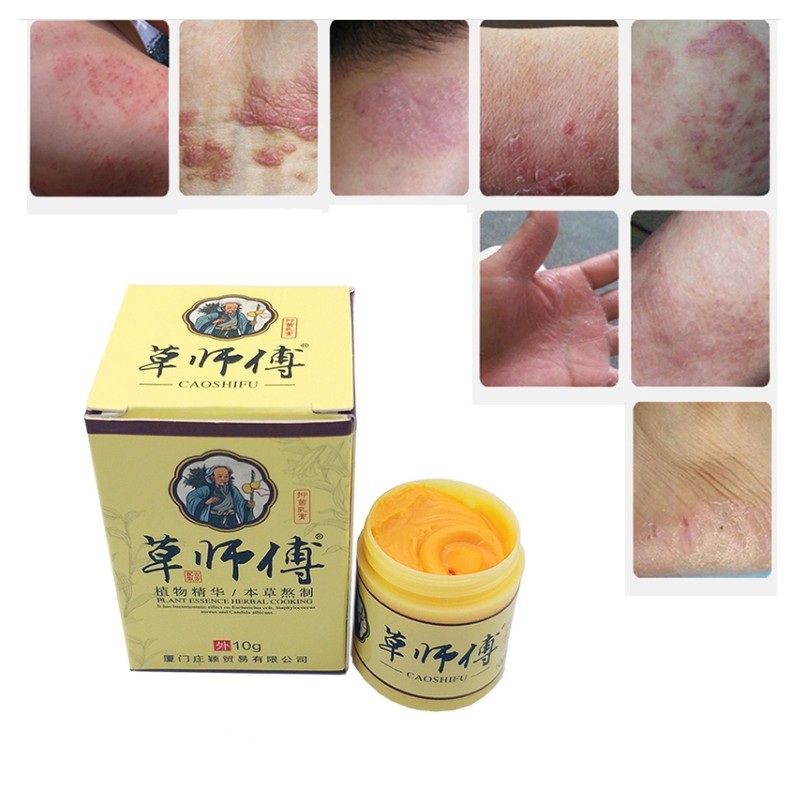 Psoriasis Cream 10g Chinese Herbal Ointment Psoriasis Ointment 7g Antibacterial Dermatitis Ointment From Caoshifu Psoriasis