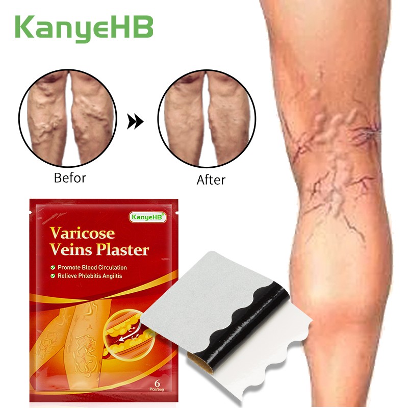 6pcs Varicose Veins Treatment Chinese Herbal Medicine Removal Phlebitis Vasculitis Spider Leg Veins Pain Plaster