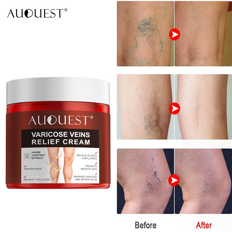 AUQUEST Varicose Veins Treatment Cream Relieve Fatigue Legs Dilatation Inflammation Felipe Vasculitis Spider Pain Relief Ointment Body Care 80g