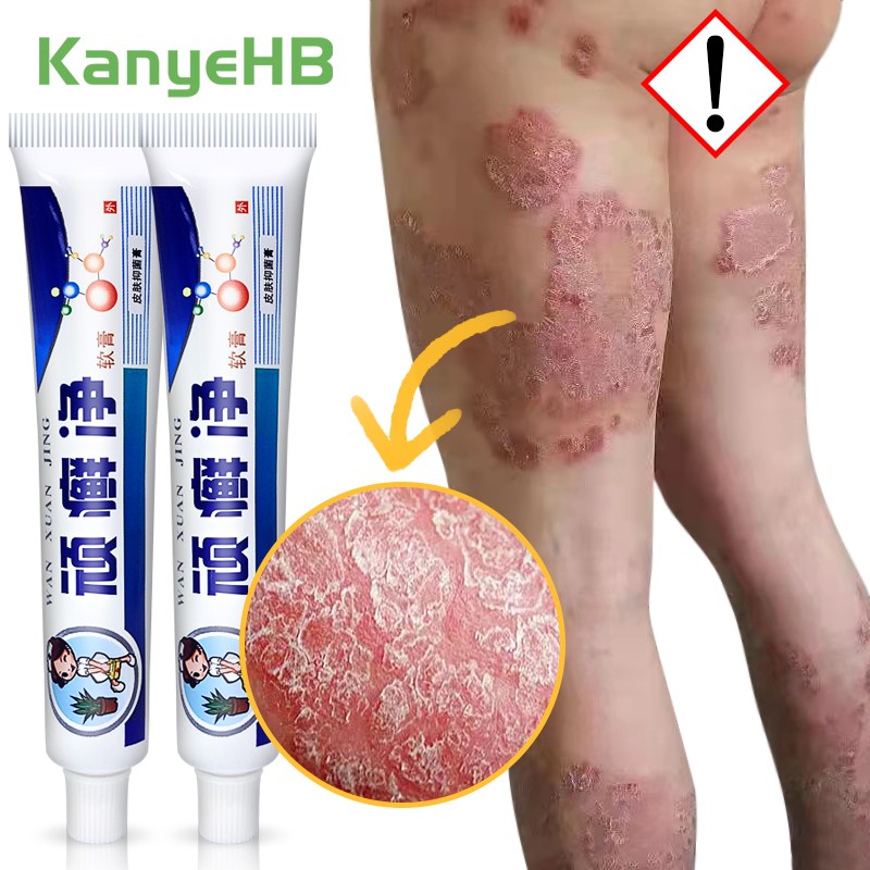 2pcs Psoriasis Cream Dermatitis Eczema Ointment Treatment Scaly Plaques Psoriasis Tina Pedis Relieve Itch Skin Care Cream A256