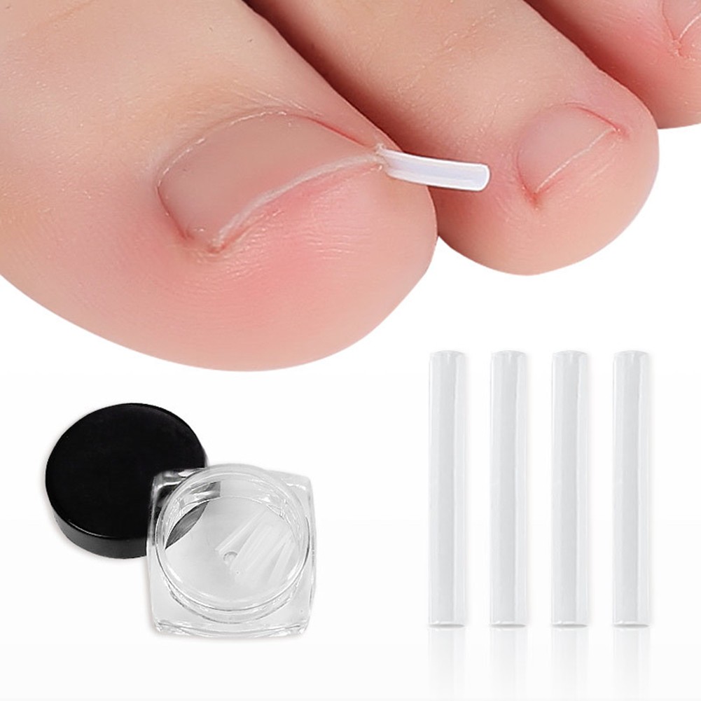 20/30/50pcs Ingrown Nail Filling Pad Relief Pain Nail Corrector Groove