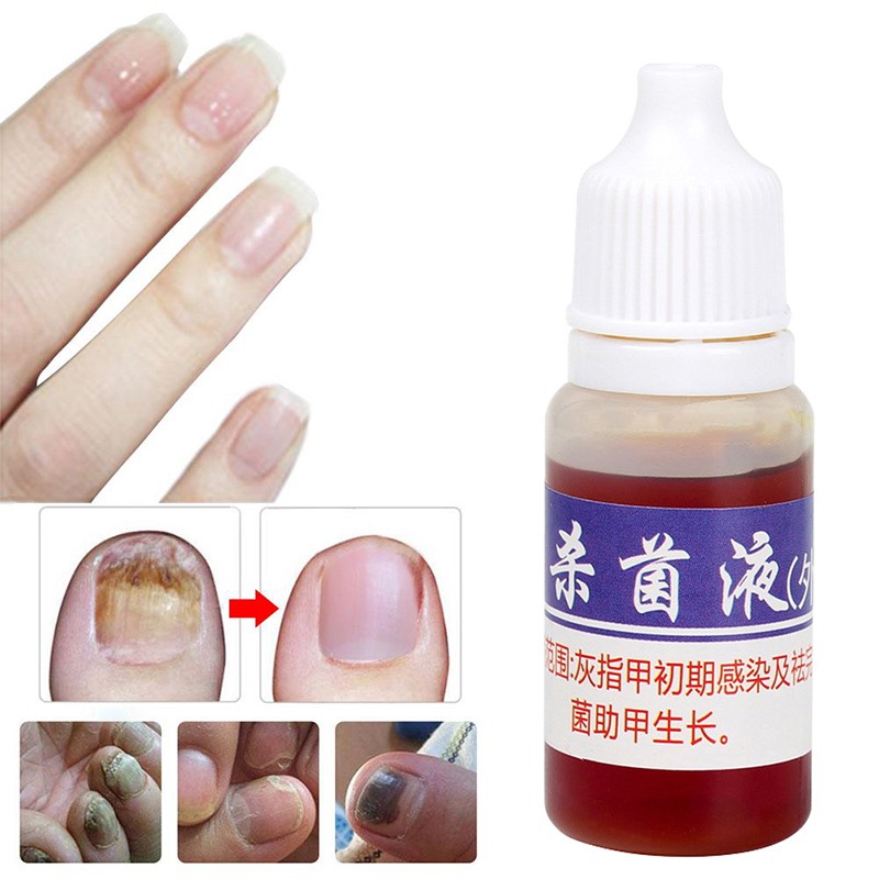 10mlFoot Fungal Care Nail Liquid Mycosis Whitening Toe Nail Fungus Removal Gel Anti Paronychia Onychomycosis Supplies