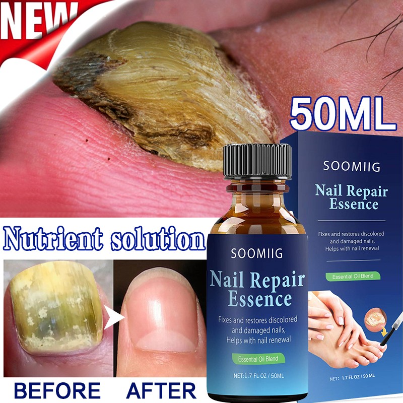 Nail Repair Serum Nail Fungal Treatment Serum Toenail Fungus Treatment Device Antifungal Toe Fungus Treatment Foot Repair Care