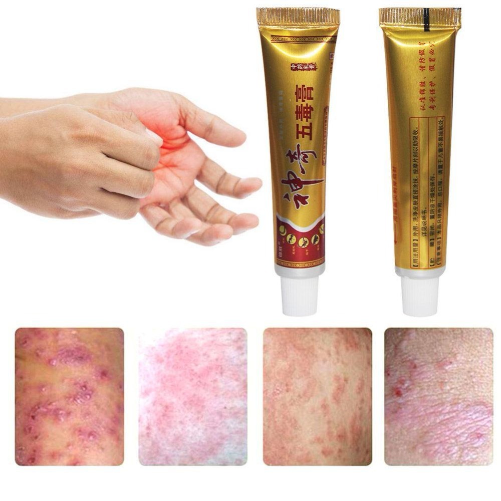 YIGANERJING Useful Psoriasis Cream (without retail box)