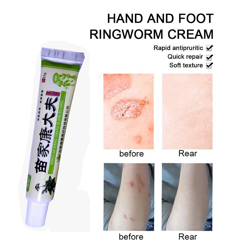 Eczema Psoriasis Antibacterial Cream Dermatitis Eczematoid Dermatitis Body Care Ointment from Psoriasis kangdaifu