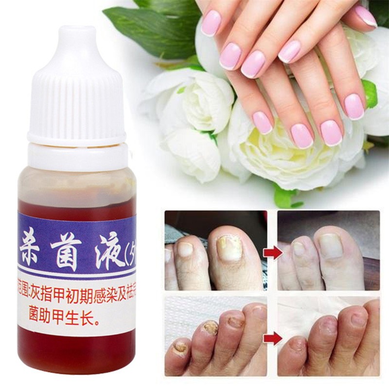 10mlFoot Fungal Care Nail Liquid Mycosis Whitening Toe Nail Fungus Removal Gel Anti Paronychia Onychomycosis Supplies