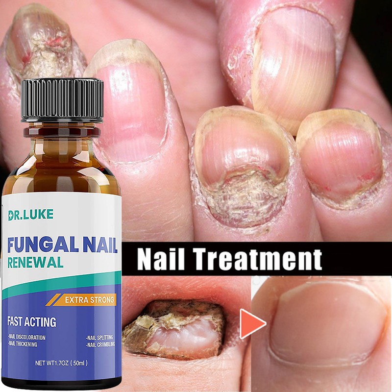 50ml Nail Repair Extract Anti Fungal Nail Treatment Remove Mycosis Nourishing Brighten Hand Foot Toes Nail Care