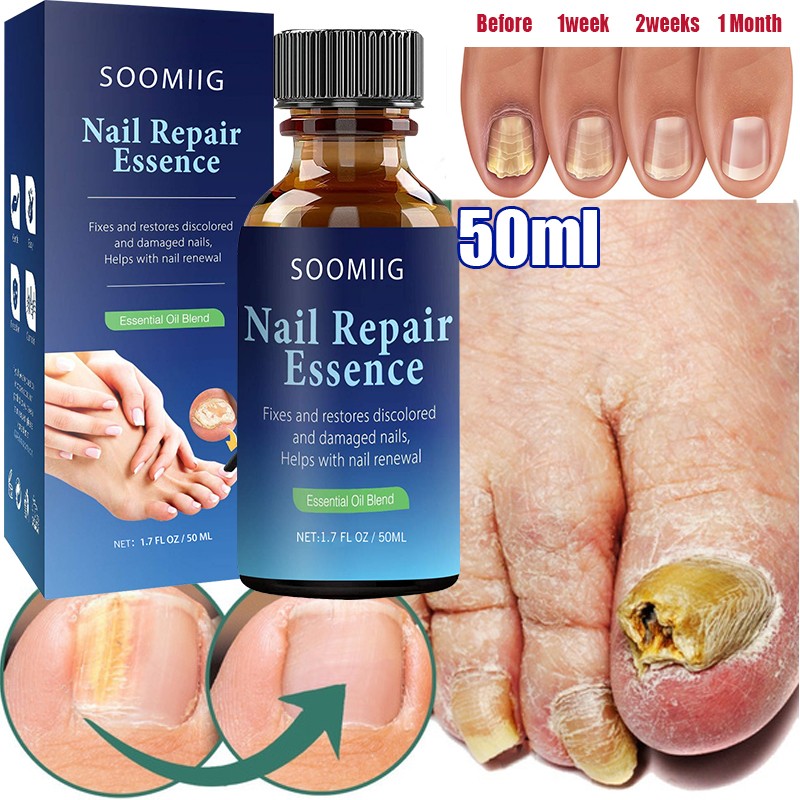 Nail Repair Serum Nail Fungal Treatment Serum Toenail Fungus Treatment Device Antifungal Toe Fungus Treatment Foot Repair Care