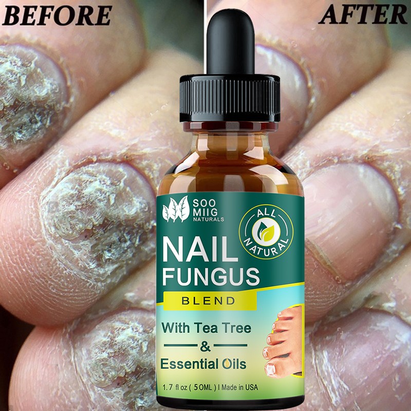 Nail Fungus Treatment Feet Care Nail Essence Repair Foot Toe Nail Fungus Removal Gel Anti Infection Paronychia Onychomycosis