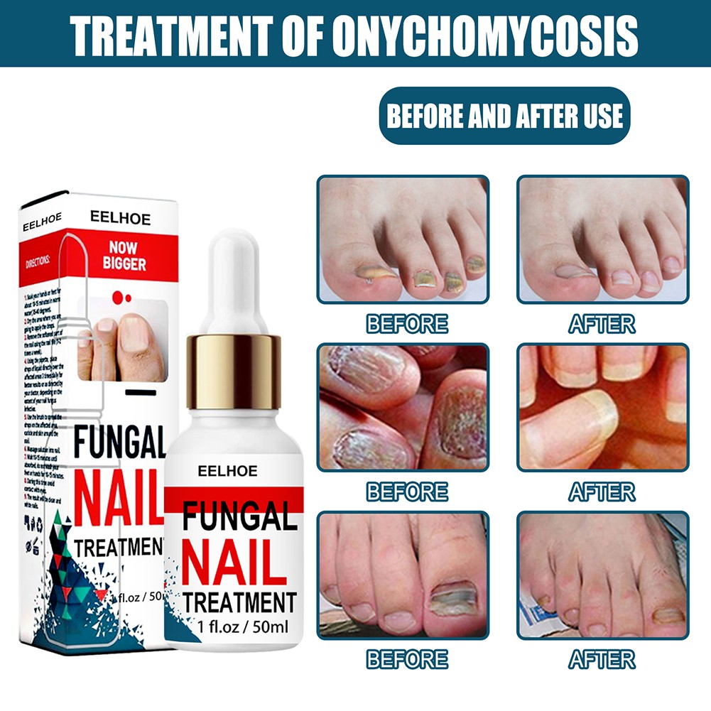 50ml Nail Repair Extract Anti Fungal Nail Treatment Remove Mycosis Nourishing Brighten Hand Foot Toes Nail Care