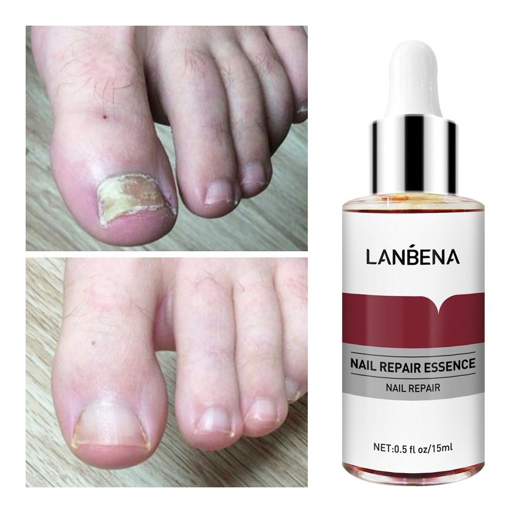 Nail Fungal Treatment Essence Foot Toe Nail Fungus Removal Gel Anti Infection Paronychia Nails Nail Repair