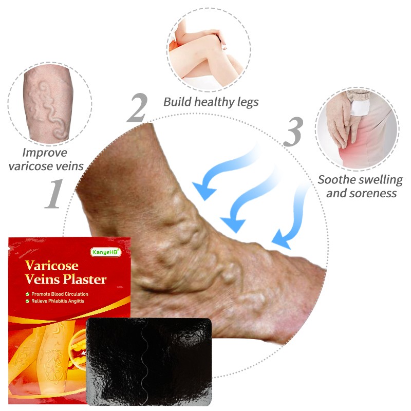 6pcs Varicose Veins Treatment Chinese Herbal Medicine Removal Phlebitis Vasculitis Spider Leg Veins Pain Plaster