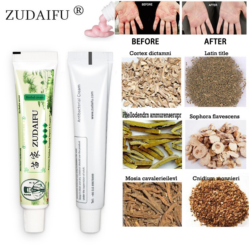 5pcs Original Zudaifu Body Psoriasis Cream Wholesale Yiganerjing 15g Without Box