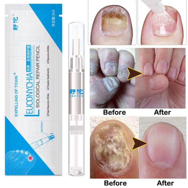 3ml Effective Nail Fungus Pen For Paronychia Infection Treatment Solution Gel Nail Treatment Essence Nutrients