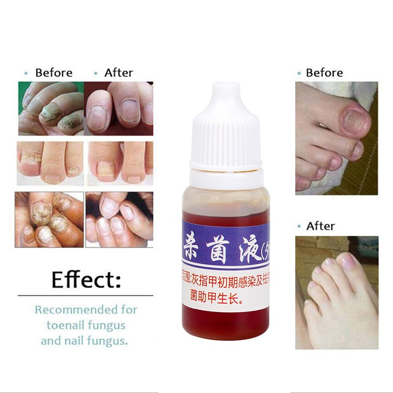 10mlFoot Fungal Care Nail Liquid Mycosis Whitening Toe Nail Fungus Removal Gel Anti Paronychia Onychomycosis Supplies