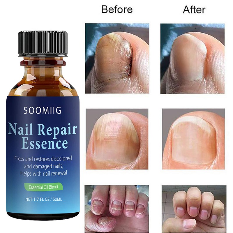 Nail Repair Serum Nail Fungal Treatment Serum Toenail Fungus Treatment Device Antifungal Toe Fungus Treatment Foot Repair Care