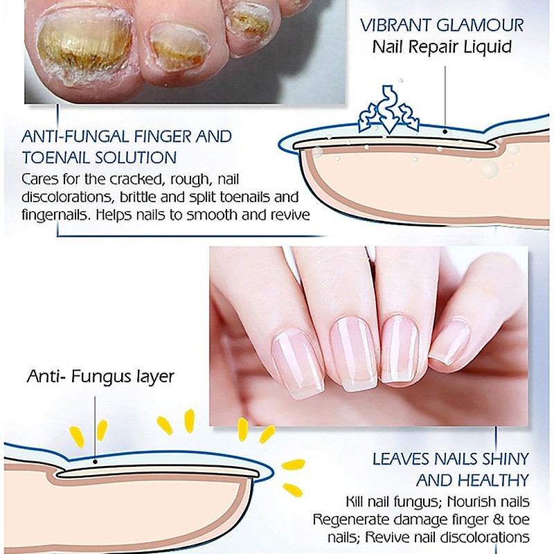 Nail Repair Serum Nail Fungal Treatment Serum Onychomycosis Paronychia Anti-Fungal Nail Infection Toe Fungus Foot Repair Care