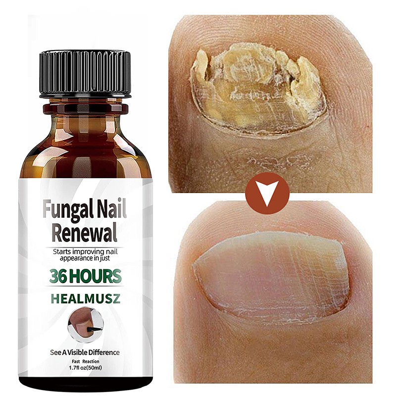 Fungal Nail Treatment Serum Onychomycosis Paronychia Anti-Fungal Nail Infection Herbal Toe Fungus Foot Repair Essence Care 50ml