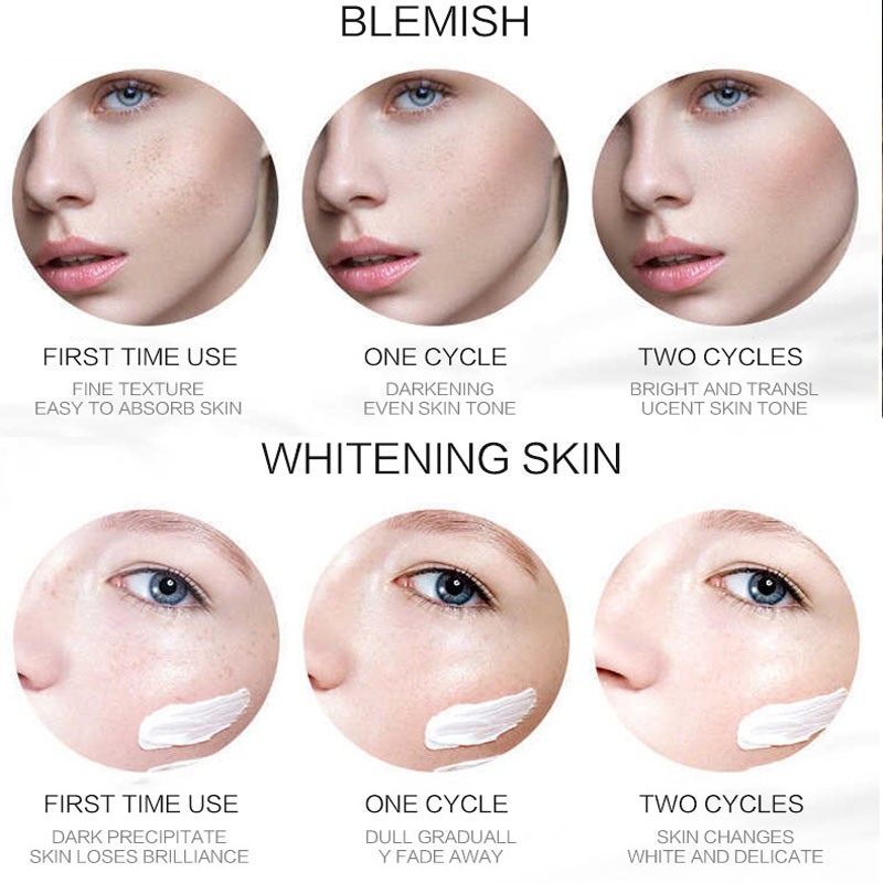 Effective Whitening Freckle Cream Gel Remove Melasma Acne Spot Pigment Melanin Dark Spots Pigmentation Moisturizing Skin Care