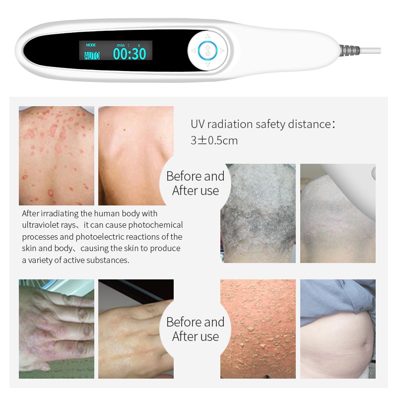 Yongrow UVB Phototherapy Instrument Vitiligo Treatment Lamp UV Treatment Psoriasis Laser Lamp Vitiligo Phototherapy