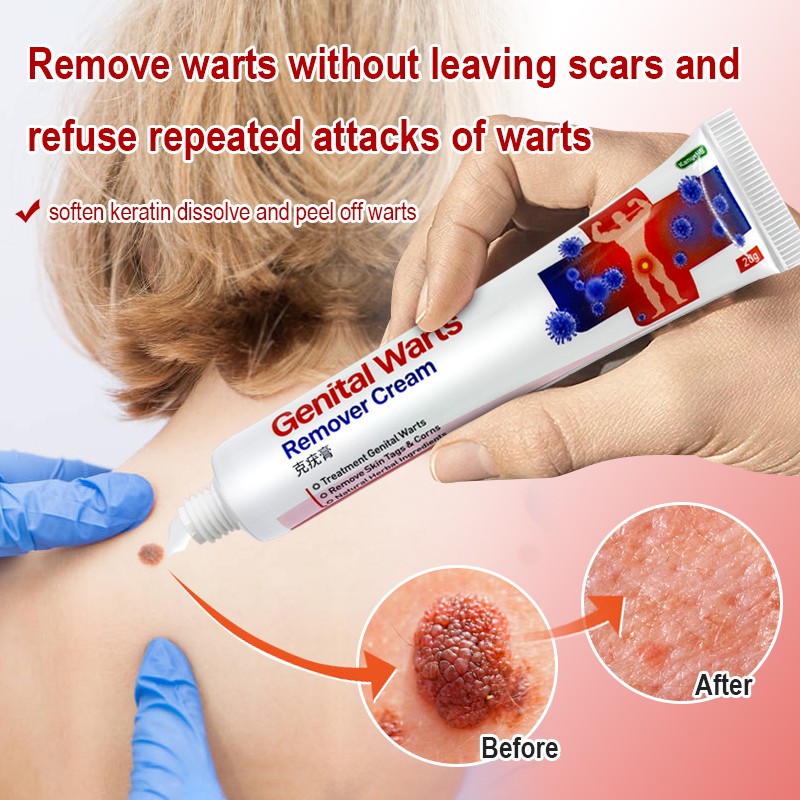 1pc Wart Remover Cream Skin Tag Mole And Papilloma Remover Treatment Private Parts Genital Wart Antibacterial Ointment G006