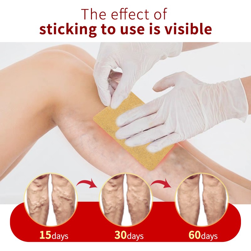 6pcs Varicose Veins Treatment Chinese Herbal Medicine Removal Phlebitis Vasculitis Spider Leg Veins Pain Plaster