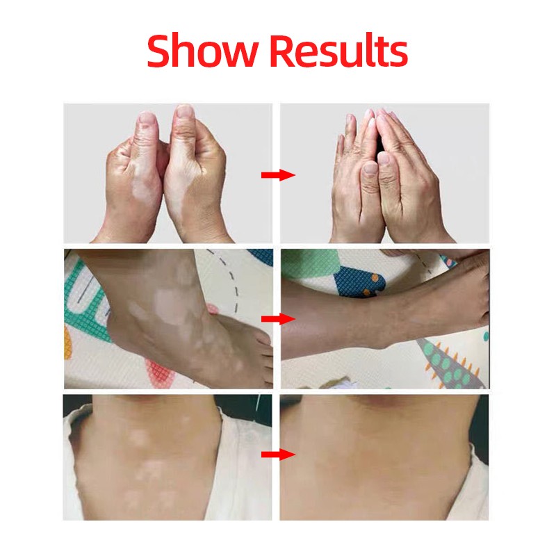 Chinese Medical Vitiligo Antibacterial Hand Spray White Spot Repair Liquid Foot Disease Leukoplakia Promote Melanin