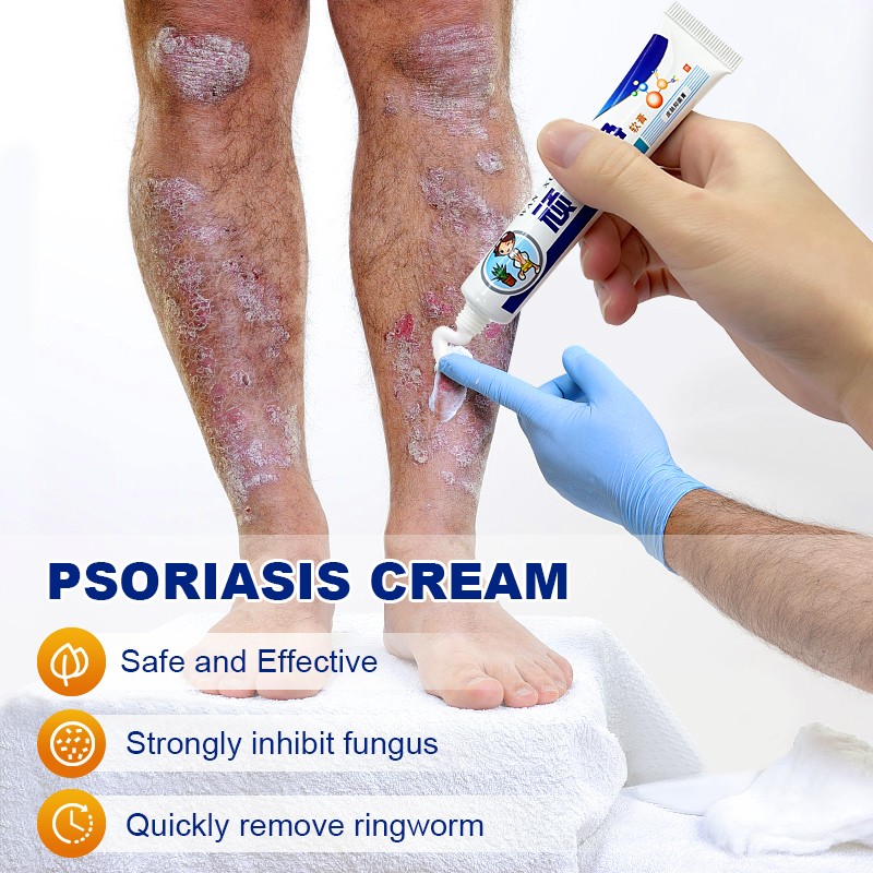 2pcs Psoriasis Cream Dermatitis Eczema Ointment Treatment Scaly Plaques Psoriasis Tina Pedis Relieve Itch Skin Care Cream A256