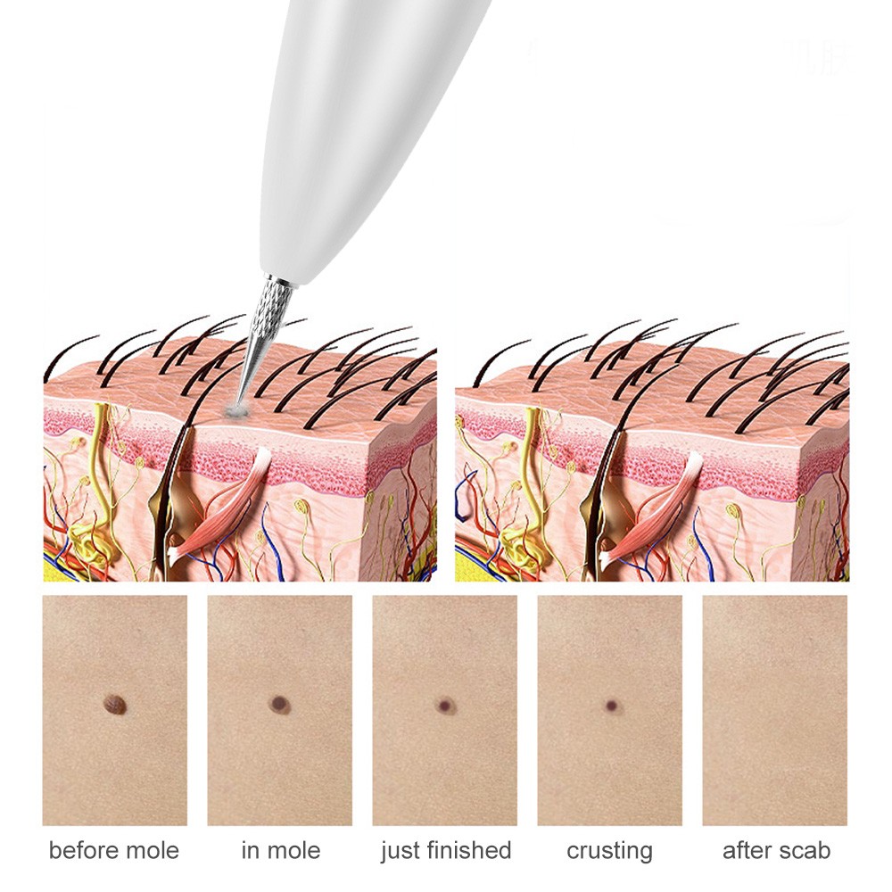 القلم صالون قلم بلازما النقاط السوداء مكنسة كهربائية ليزر إزالة النمش آلة الجلد الخلد بقعة داكنة الوجه ثؤلول العلامة مزيل الوشم
