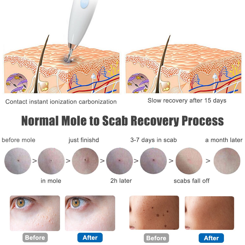 LCD الخلد إزالة النمش القلم إزالة ثؤلول بقعة قلم بلازما الوشم الأسود نقطة مزيل الوجه الجسم نظيفة الجمال العناية بالبشرة أداة