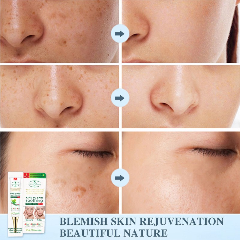 Effective Whitening Freckle Cream Gel Remove Melasma Acne Spot Pigment Melanin Dark Spots Pigmentation Moisturizing Skin Care