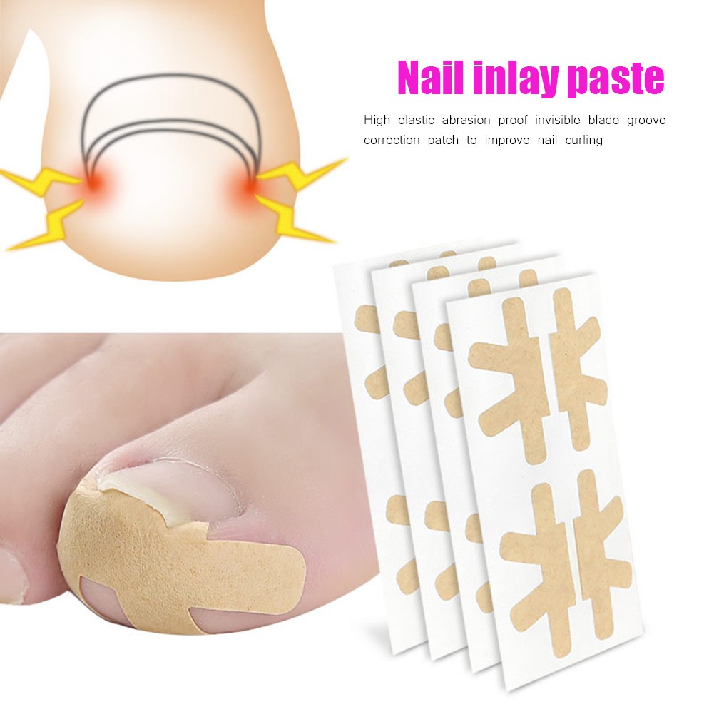 Professional Paronychia Treatment Sticker Ingrown Toenail Nail Corrector Ingrown Feet Care Tools Pedicure Toenail Care