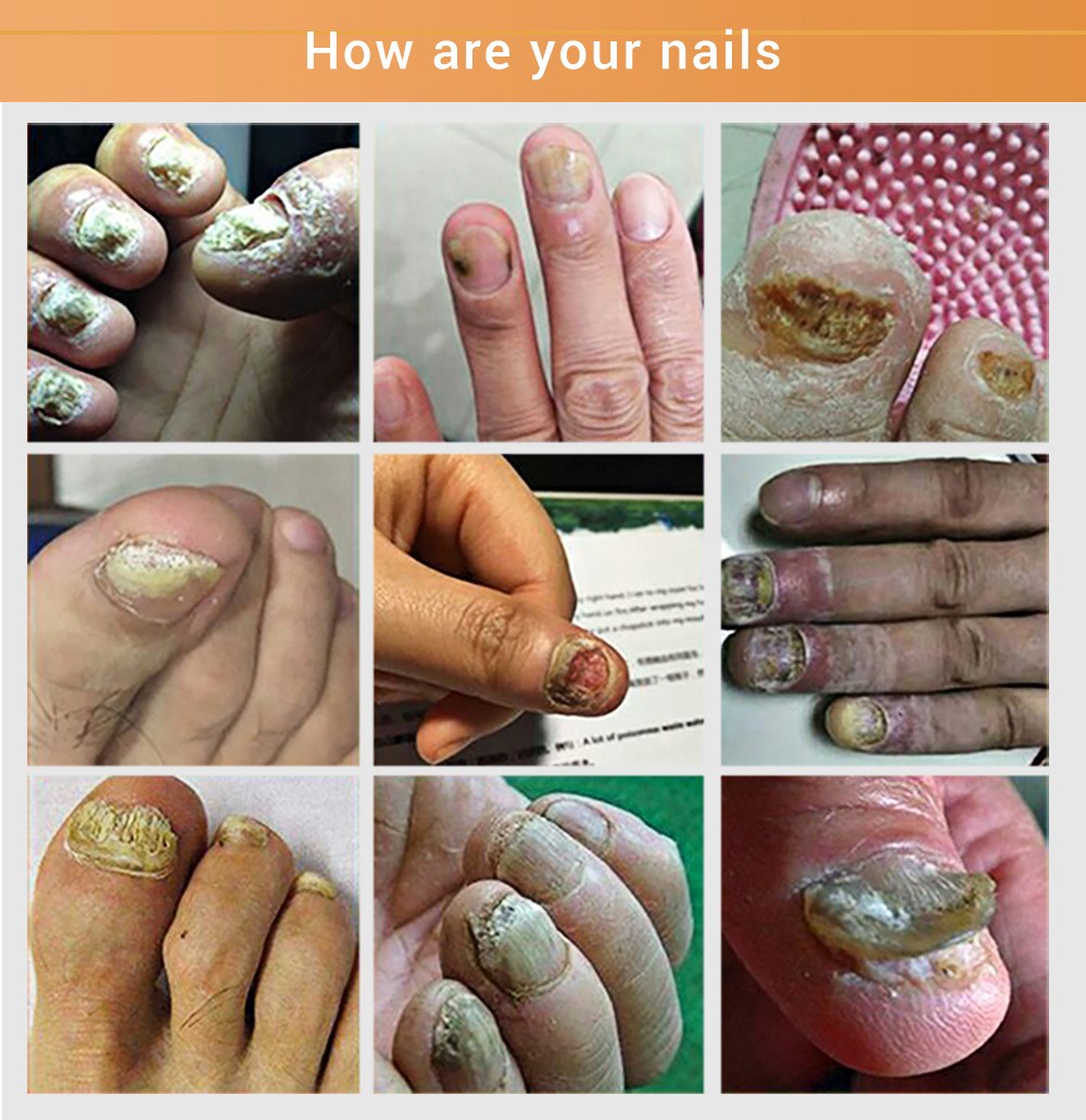 Nail Fungal Treatment Essence Foot Toe Nail Fungus Removal Gel Anti Infection Paronychia Nails Nail Repair