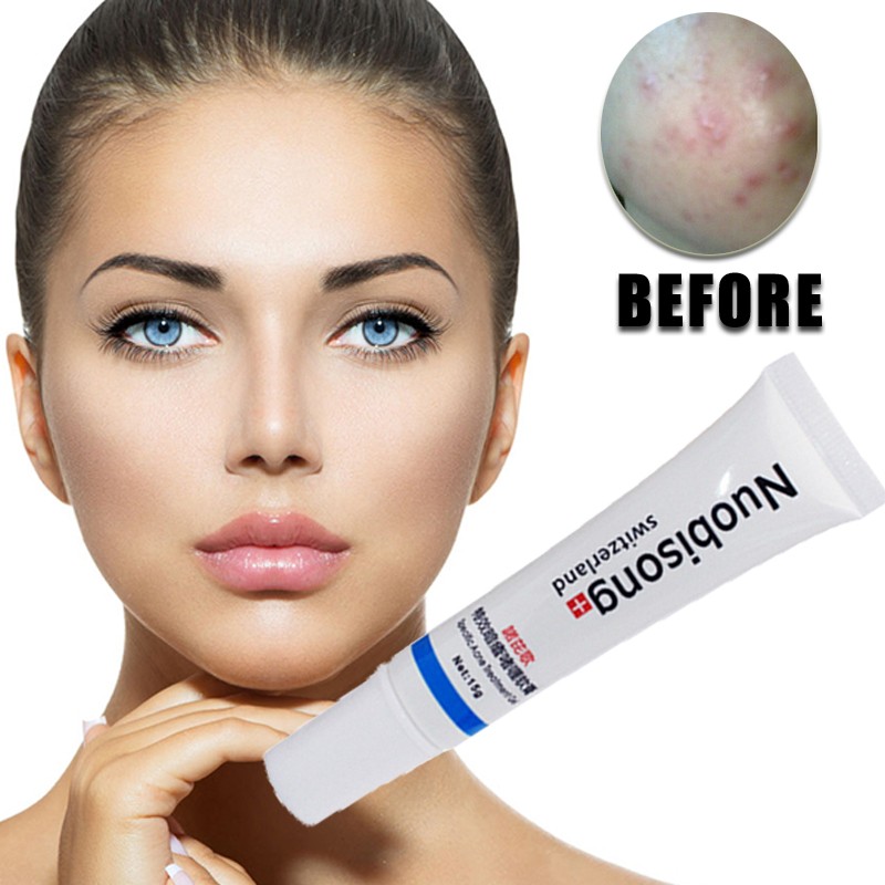 Nuobisong Face Skin Care Treatment Facial Pimples Scar Stretch Marks Removal Acne Treatment Whitening Moisturizing Cream