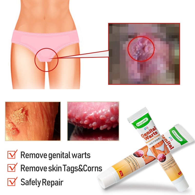 2pcs Wart Remover Ointment Genital Herpes Congenital Vulva Acuminatum Skin Tag Remover Antibacterial Treatment Cream A658