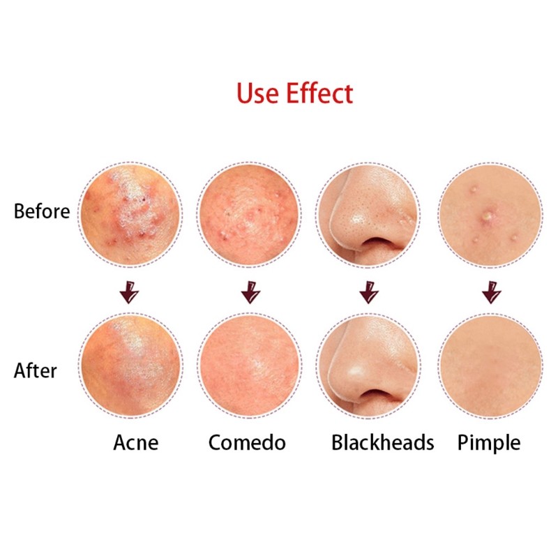 4 قطعة/المجموعة حب الشباب البثرة بثرة علاج دبوس أطقم Comedone دبوس إبرة أداة