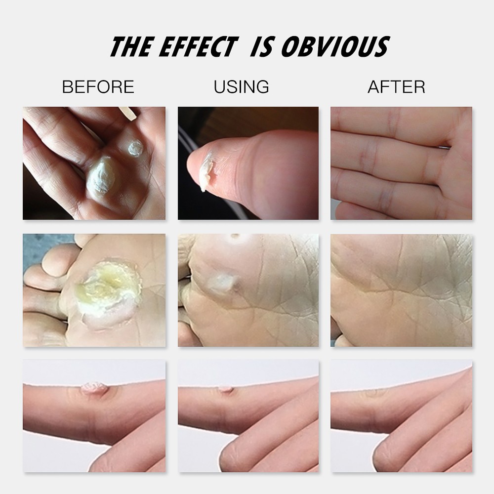 Medical foot care remove corns pads warts thorn treatment cream calluses remove callusitis detox professional foot cream