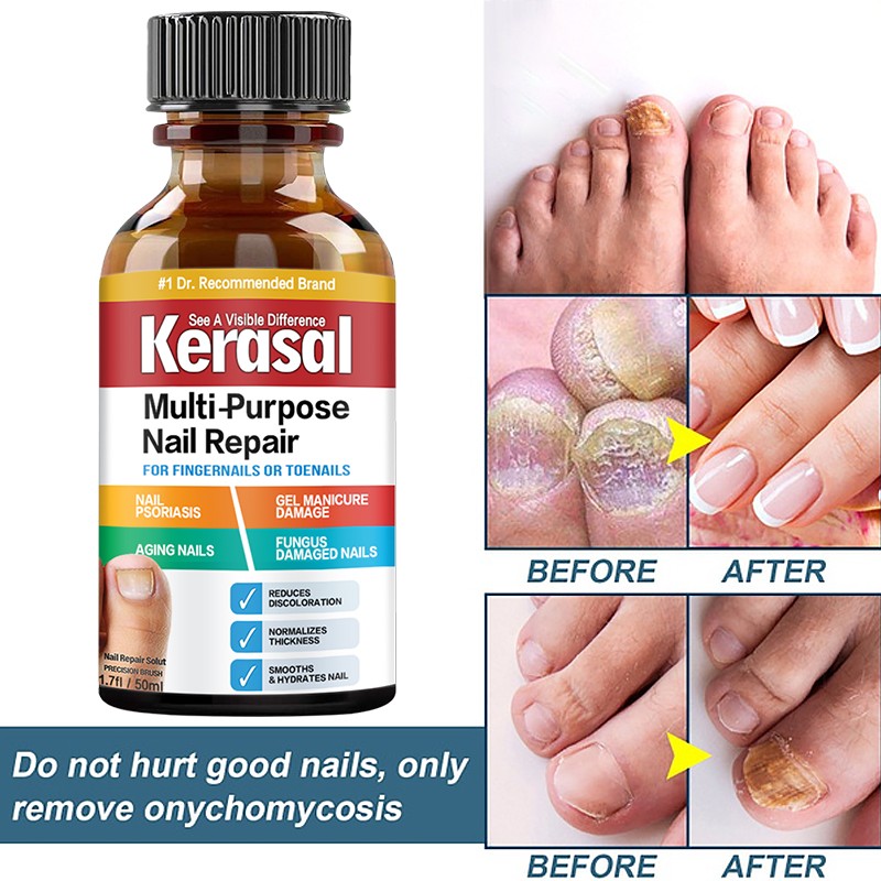 Nail Repair Serum Nail Fungal Treatment Serum Onychomycosis Paronychia Anti-Fungal Nail Infection Toe Fungus Foot Repair Care