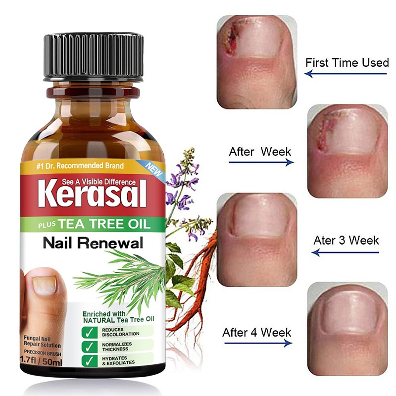 Fungal Nail Treatment Essential Oil Whitening Hand And Foot Toe Nail Fungus Remove Infection Feet Care Polish Nail Gel 50ml