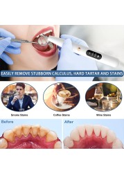 قشارة الأسنان بالموجات فوق الصوتية لحساب التفاضل والتكامل للأسنان الكهربائية التتار التفاضل والتكامل مزيل بقع البلاك إزالة حجر الأسنان مع Led