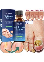 Nail Repair Serum Nail Fungal Treatment Serum Toenail Fungus Treatment Device Antifungal Toe Fungus Treatment Foot Repair Care