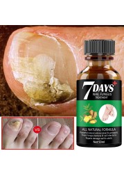 Nail Repair Serum Nail Fungal Treatment Serum Toenail Fungus Treatment Device Antifungal Toe Fungus Treatment Foot Repair Care