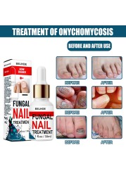 50ml Nail Repair Extract Anti Fungal Nail Treatment Remove Mycosis Nourishing Brighten Hand Foot Toes Nail Care