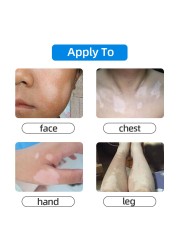 Chinese Medical Vitiligo Antibacterial Hand Spray White Spot Repair Liquid Foot Disease Leukoplakia Promote Melanin