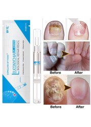 3ml Effective Nail Fungus Pen For Paronychia Infection Treatment Solution Gel Nail Treatment Essence Nutrients