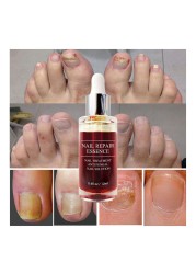 LANBENA - Fungus repair serum, nail care treatment, anti-infective gel, paronychia, onychomycosis