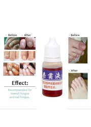 10mlFoot Fungal Care Nail Liquid Mycosis Whitening Toe Nail Fungus Removal Gel Anti Paronychia Onychomycosis Supplies