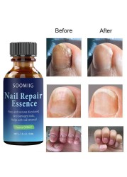 Nail Repair Serum Nail Fungal Treatment Serum Toenail Fungus Treatment Device Antifungal Toe Fungus Treatment Foot Repair Care