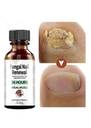 Fungal Nail Treatment Serum Onychomycosis Paronychia Anti-Fungal Nail Infection Herbal Toe Fungus Foot Repair Essence Care 50ml