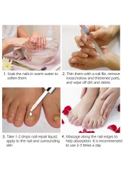 3pcs Nail Fungal Treatment Feet Care Essence Nail Whitening Toe Nail Fungus Removal Gel Anti Infection Paronychia Video